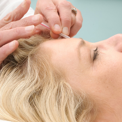 face of woman recieving acupuncture care.