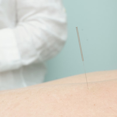 single acupuncture needle in womans back.