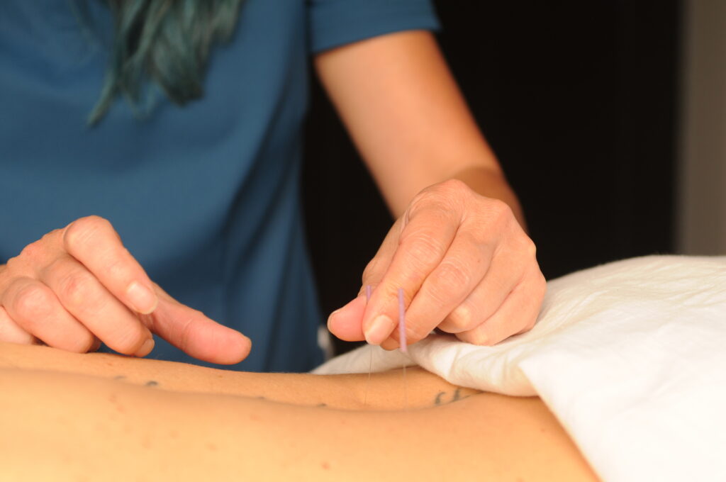 Acupuncture for endometriosis and fertility at Acupuncture Denver